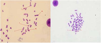 Case Report: Occupation Radiation Disease, Skin Injury, and Leukemia After Accidental Radiation Exposure